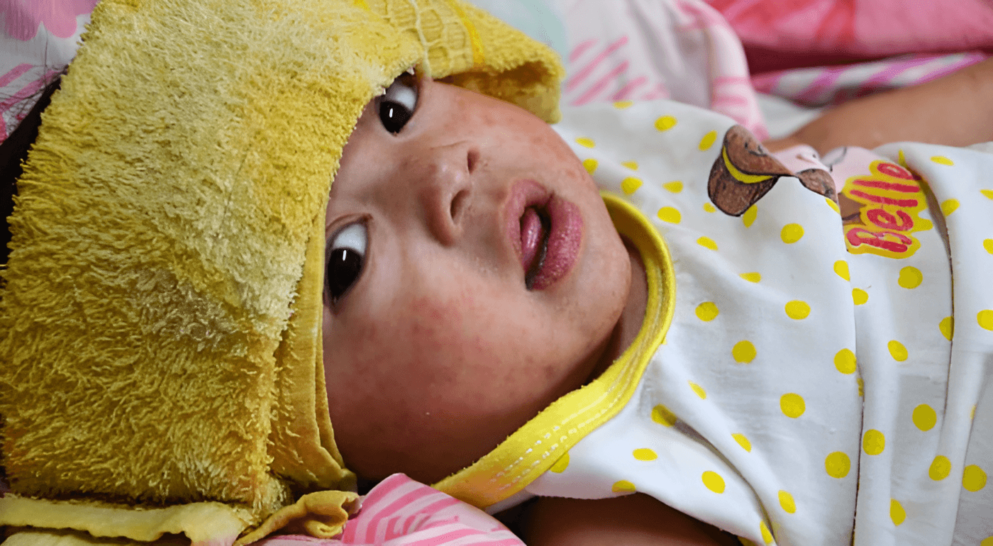 Close-up of measles rash on child’s skin during Texas outbreak.